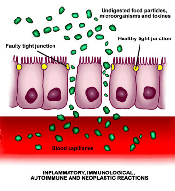 graphic showing faulty junctions in gut and healthy tight junction sin gut.